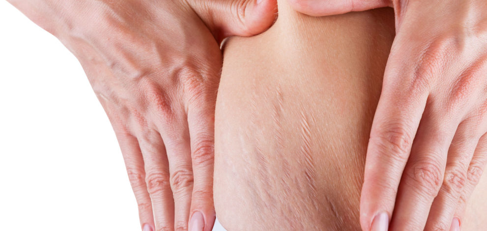 cellulite
