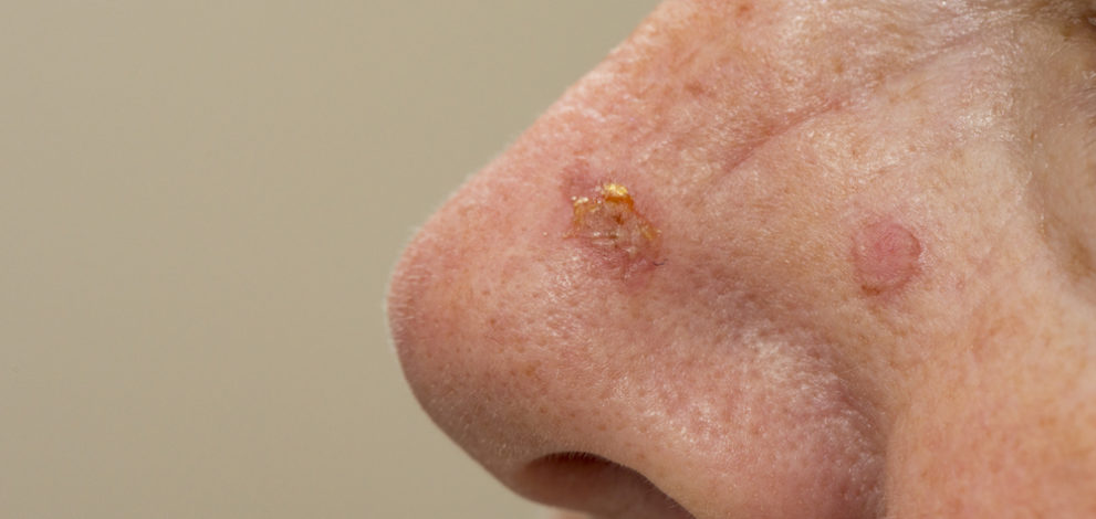 pictures-of-early-skin-cancer-on-nose-cancerwalls