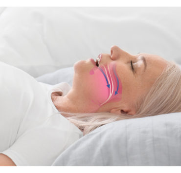 obstructive sleep apnea
