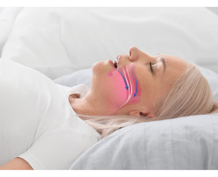 obstructive sleep apnea